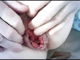 Prolapse rosebud