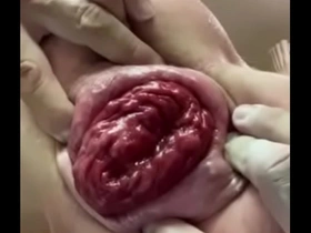 Anal prolaspe